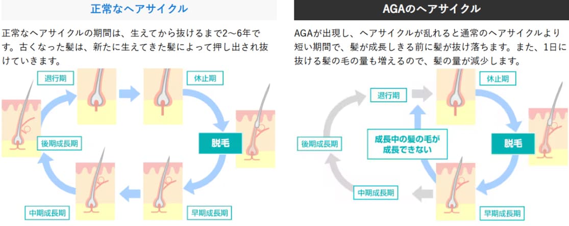 AGAは早期治療が大事！