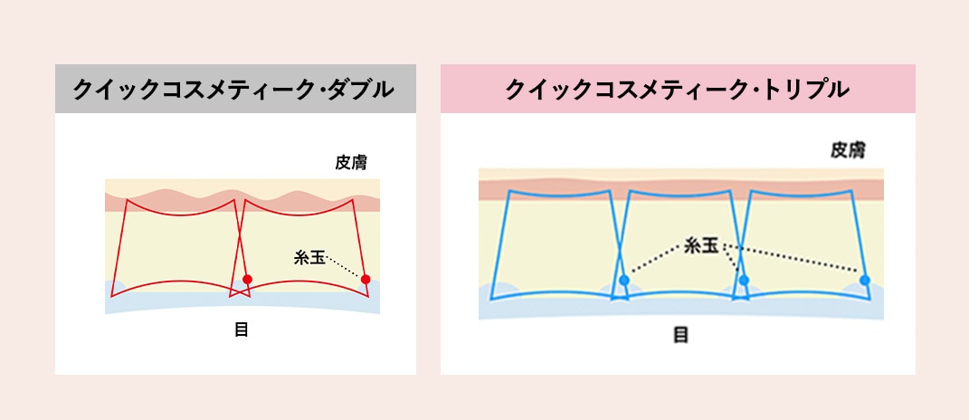 3本の糸で支え合うからライン持続性が強い