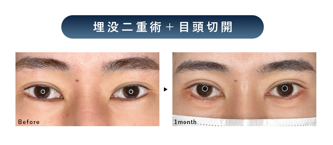 埋没二重術＋目頭切開