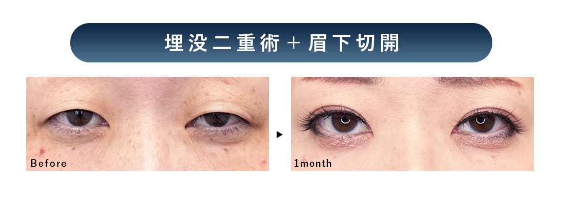 埋没二重術＋眉下切開