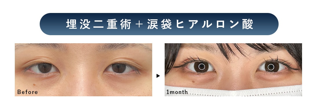 埋没二重術＋涙袋ヒアルロン酸