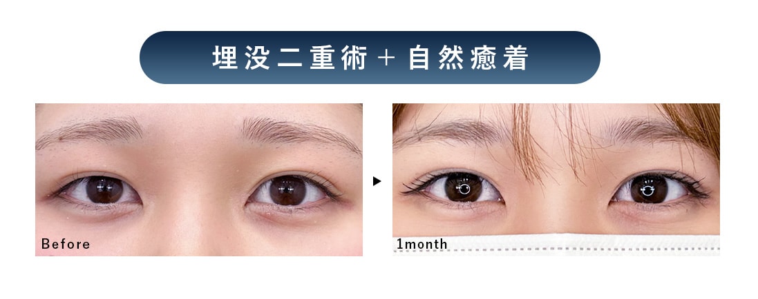 埋没二重術＋自然癒着法