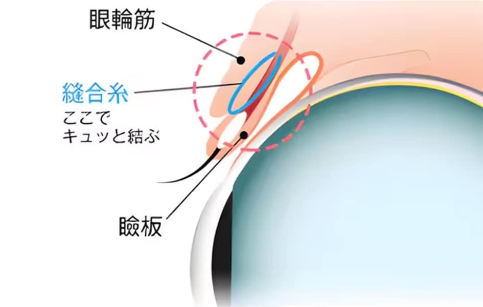 最も取れづらく、腫れづらく、バレにくい二重術