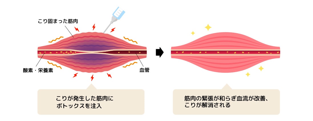 ボトックスの仕組みと原因