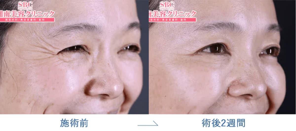 目尻