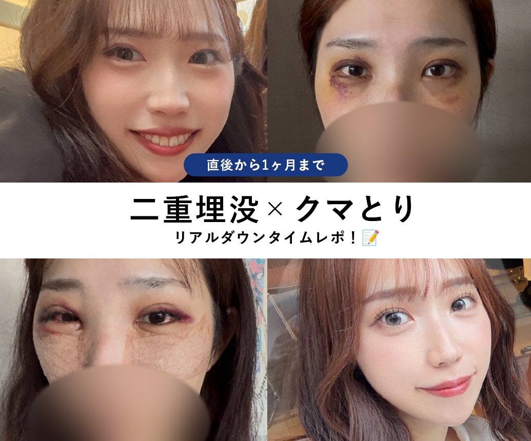 【二重整形＆裏ハムラ法】クマ取り＋二重埋没でどれくらい変わる？スタッフ症例を写真付きで紹介