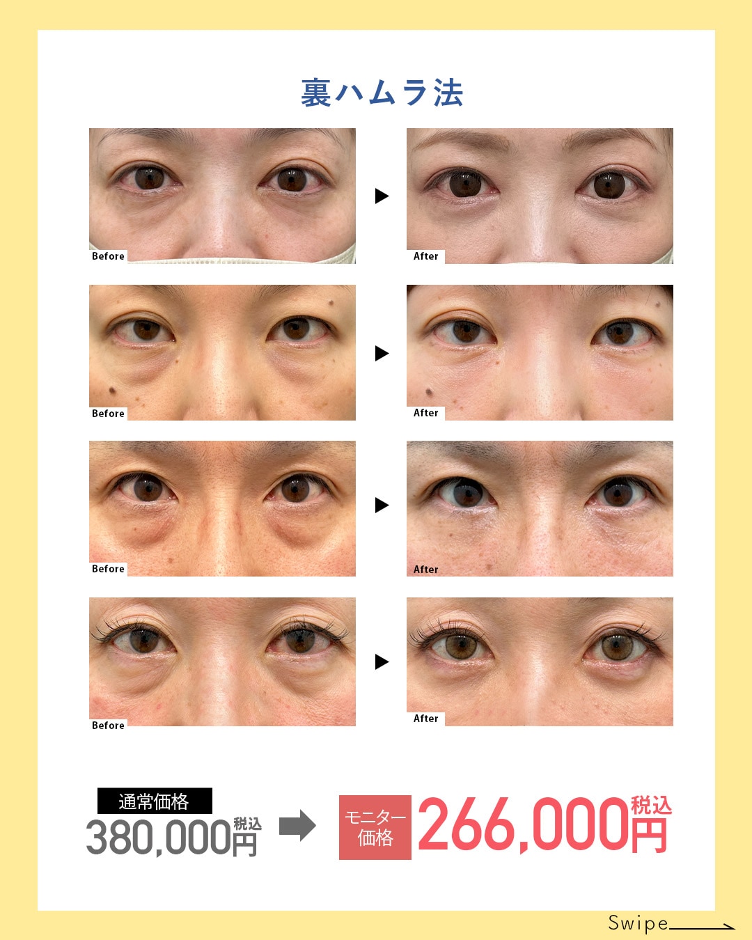 裏ハムラ法