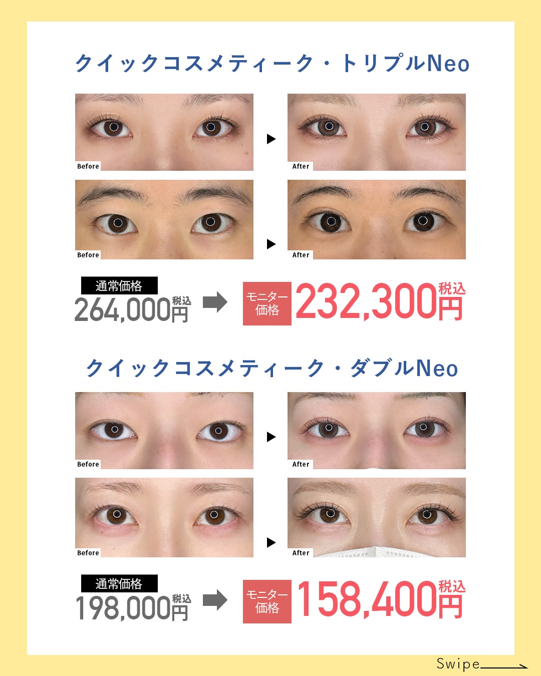 二重整形