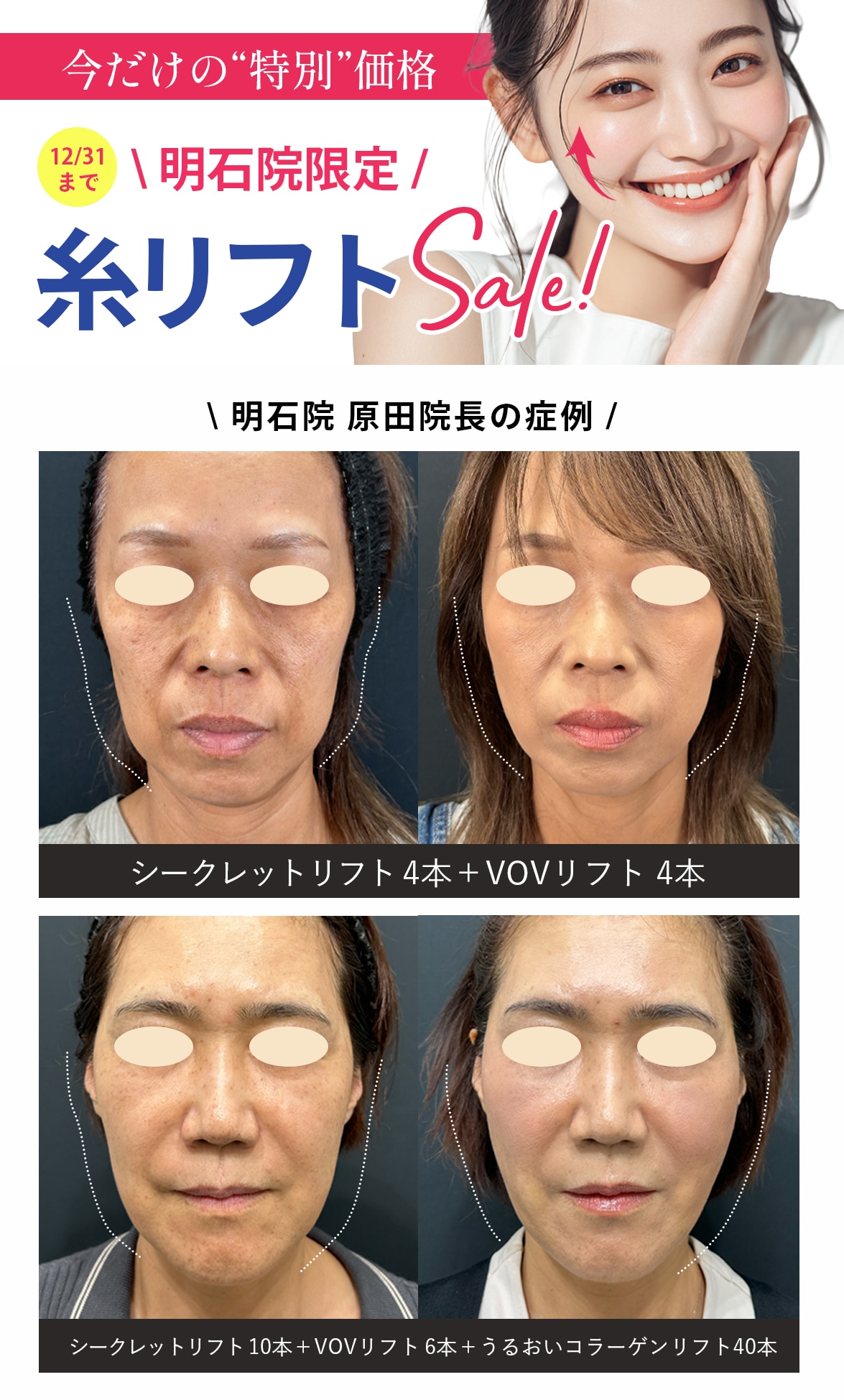 明石院限定 糸リフトSale!