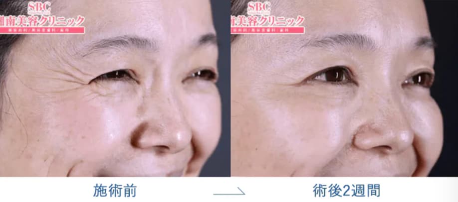 目尻