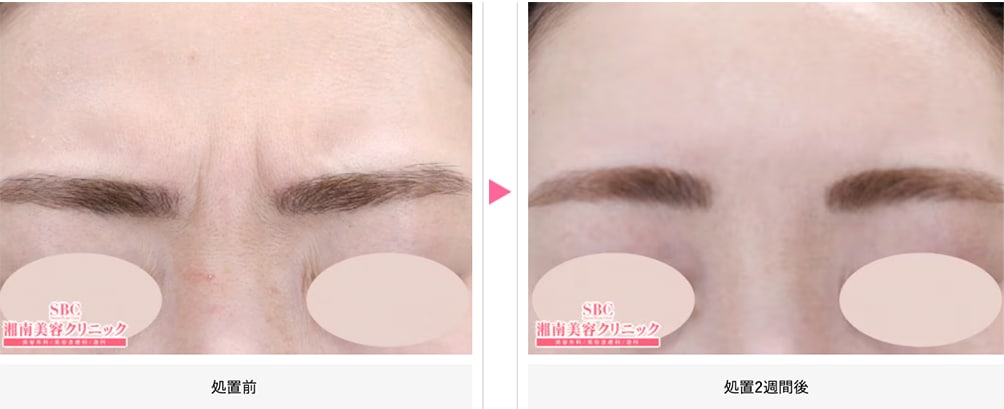 ボトックス症例写真