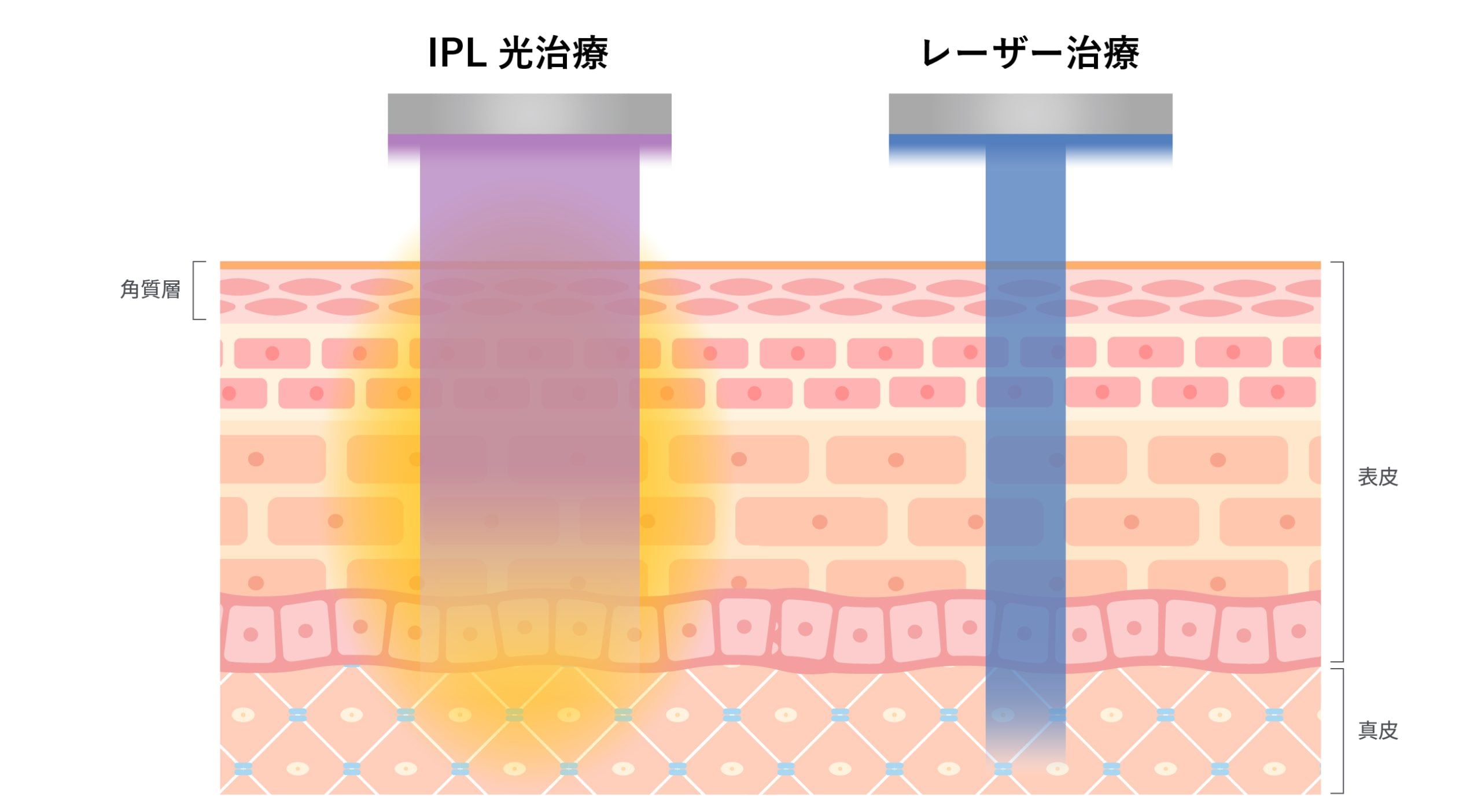 IPL（光治療）の特徴とは？