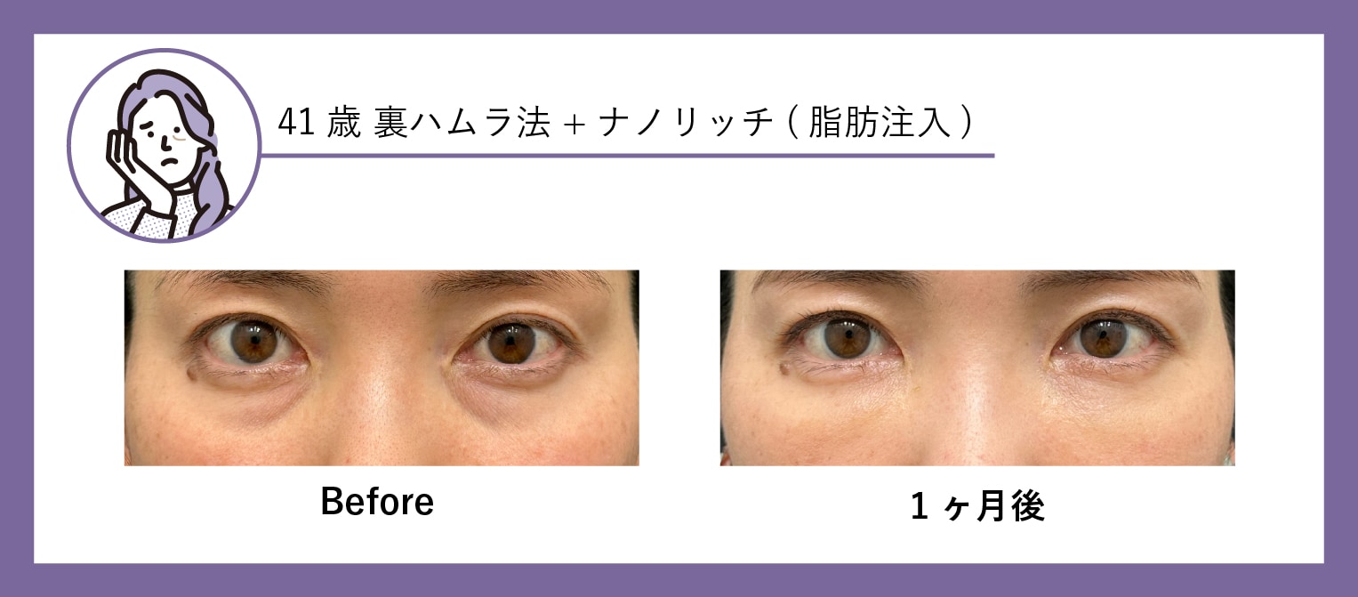 40代 クマ取り症例