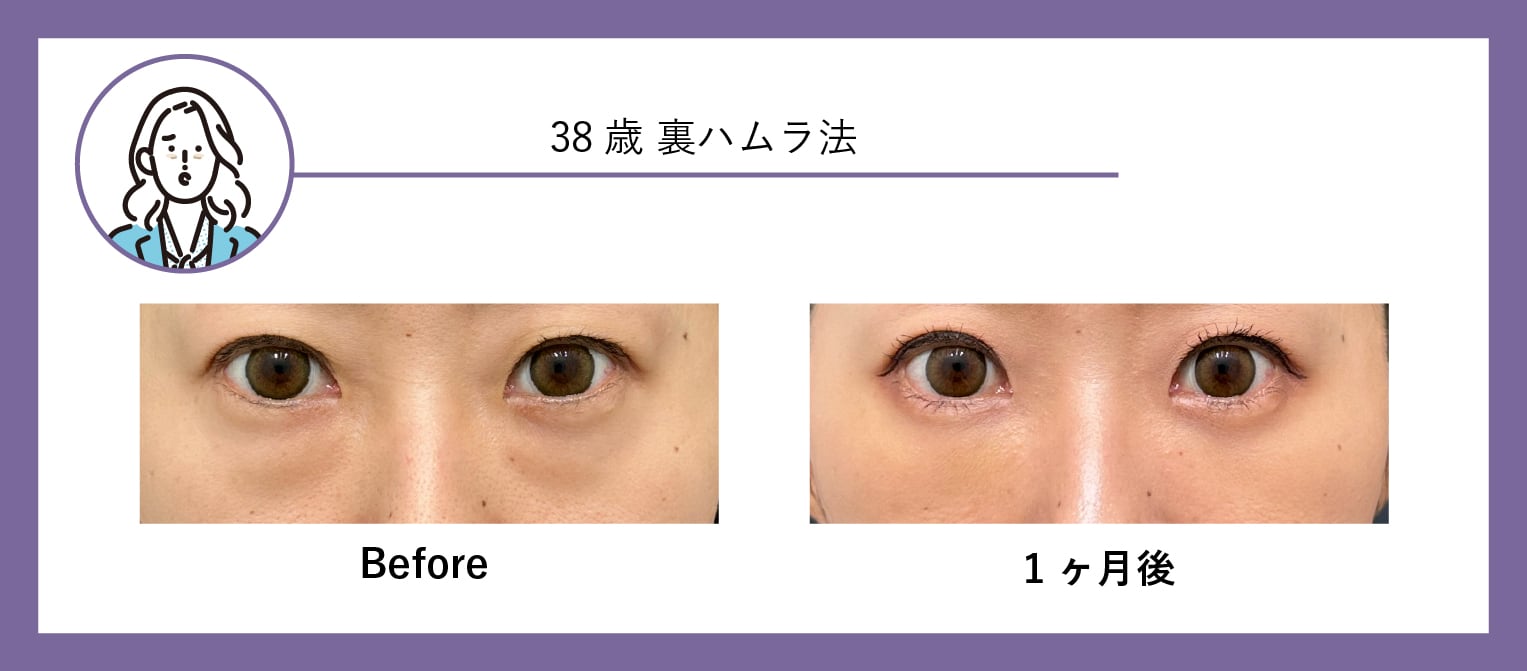 30代 クマ取り症例