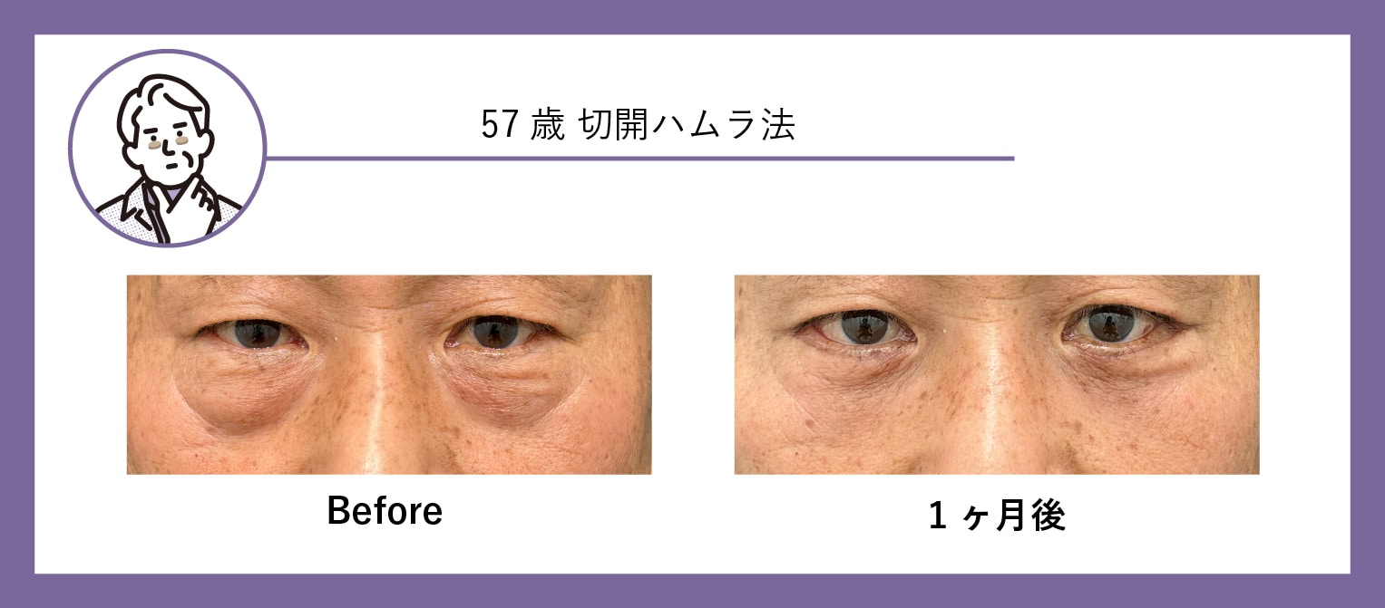 50代 クマ取り症例