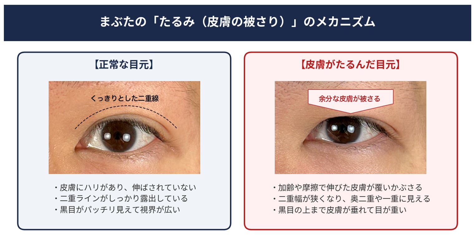 まぶたの皮膚の被さり・たるみのメカニズム図解