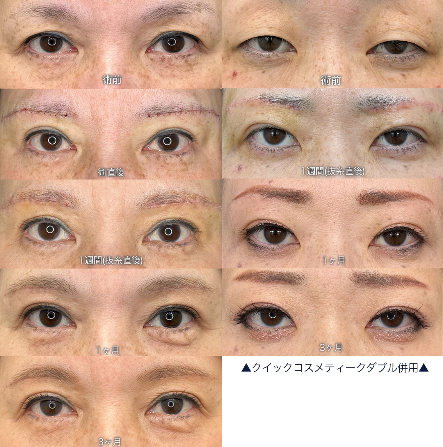 眉下リフト ダウンタイム経過写真