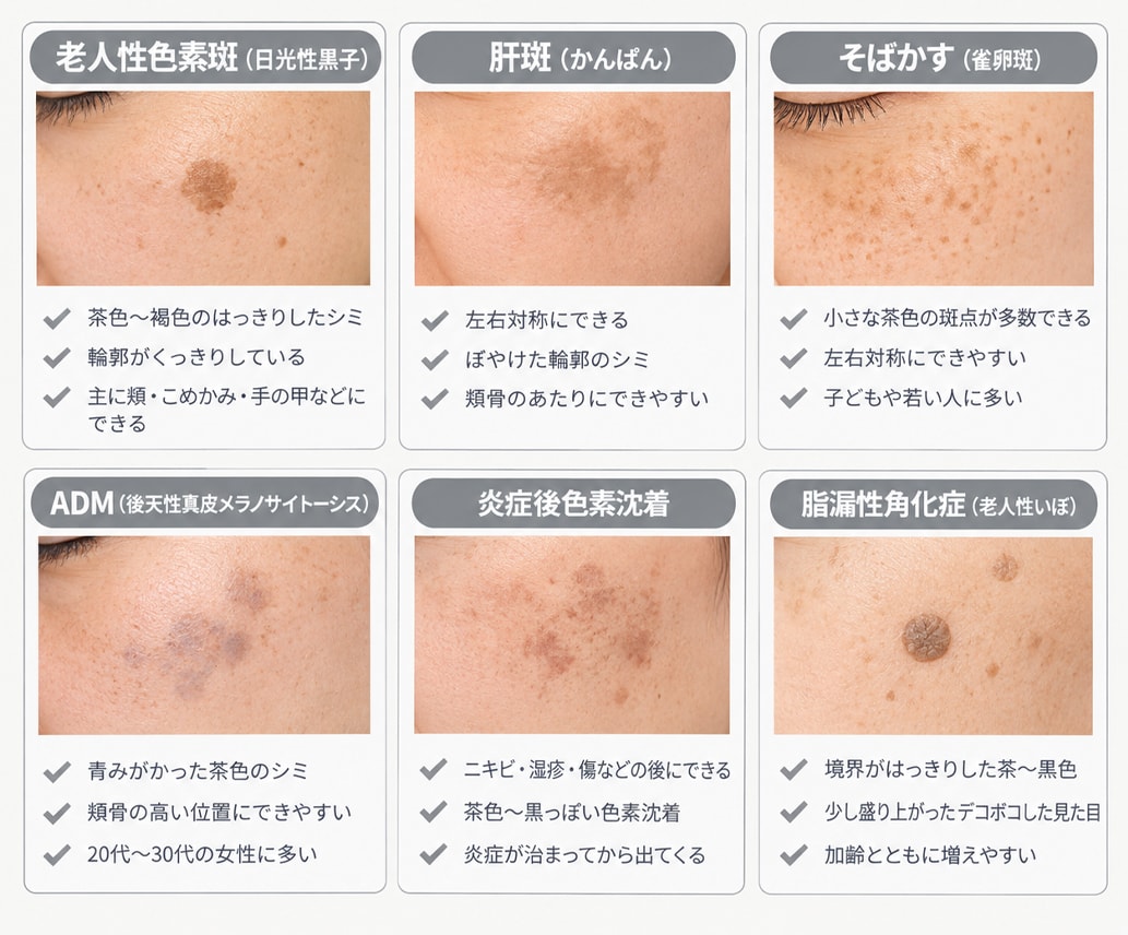 無料シミ診断】あなたのシミ・肝斑に最適な治療は？湘南美容クリニック