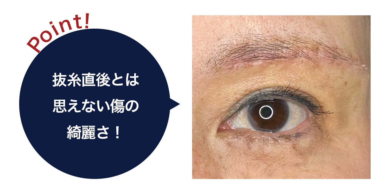 眉下リフト 抜糸直後の傷痕 Point 原田院長