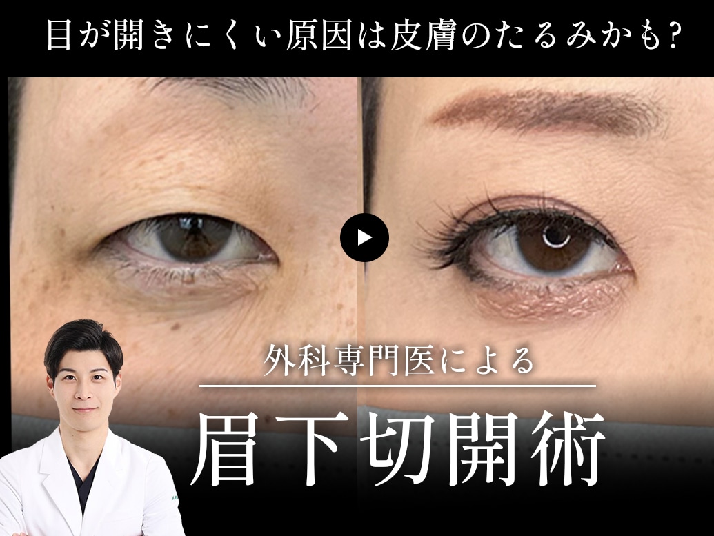 【明石・神戸・三宮】目が重い・開きにくい原因は皮膚のたるみ？眉下切開（眉下リフト）が適応かも？名医が解説いたします！