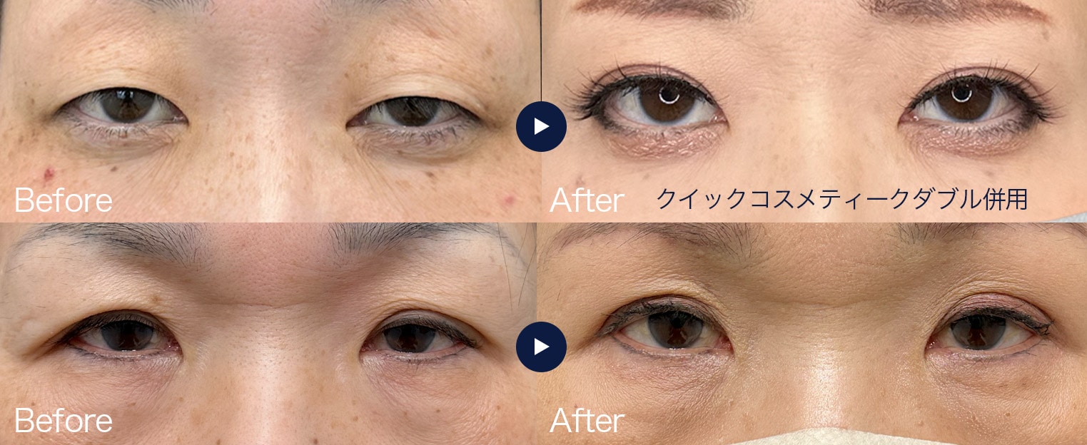 https://www.s-b-c.net/clinic/branch/akashi/wp-content/uploads/sites/142/2026/10/眉下症例3.jpg
