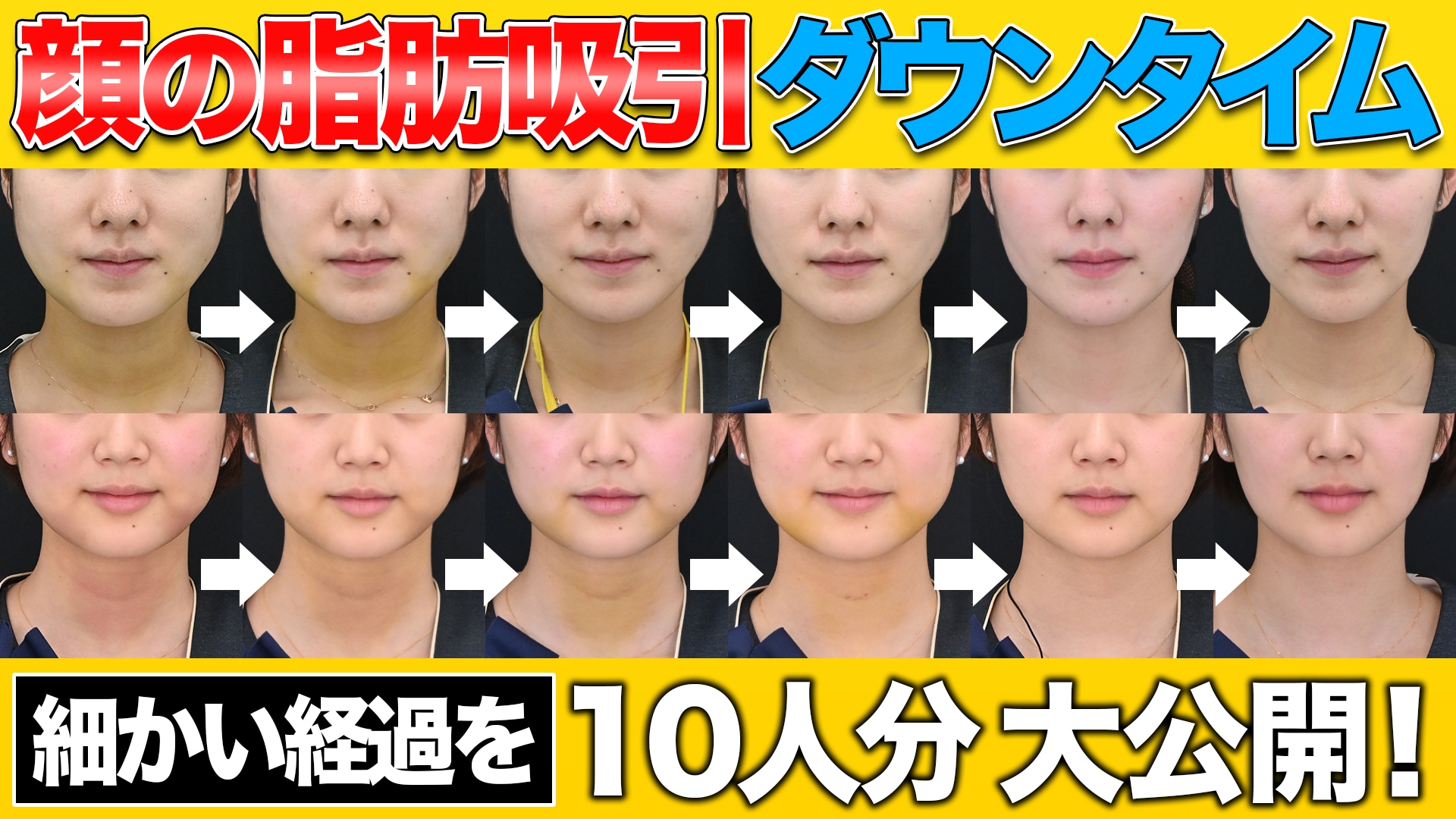 脂肪 吸引 ダウン タイム 顔