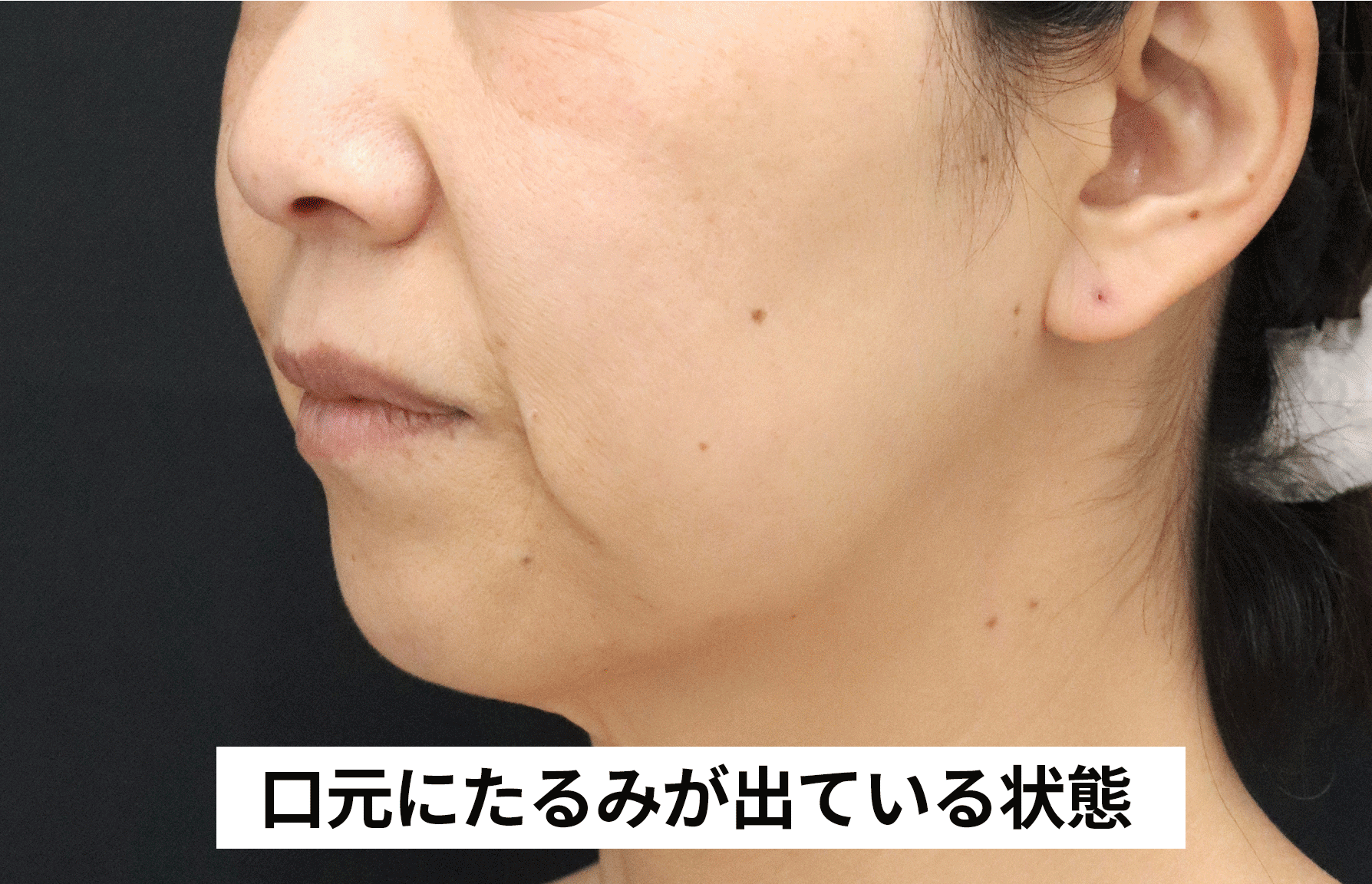 ハイフ金ドブ？】ハイフは効果ない？金ドブ治療にしない効果的な方法と 