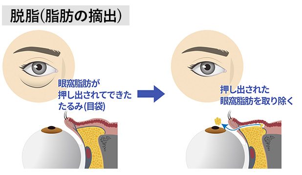 「膨らみ」は取れるが「凹み」は残ることも