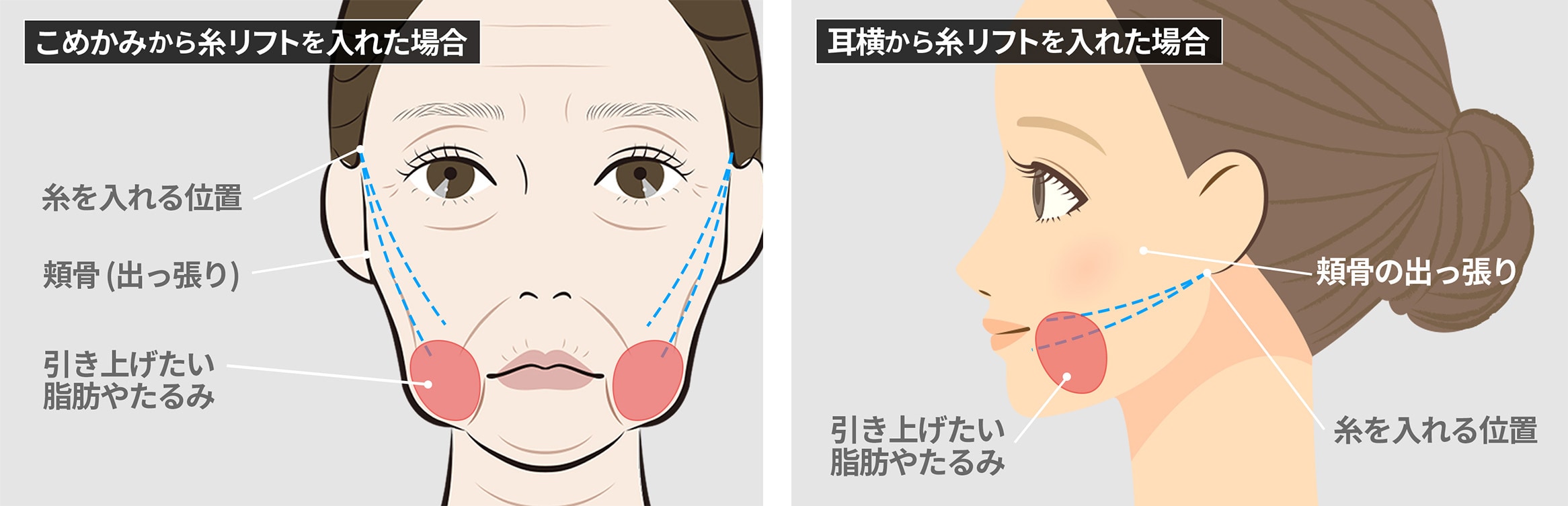 [Japan’s No.1 Expert Explains] Preventing Thread Lift Failures! What Is ...