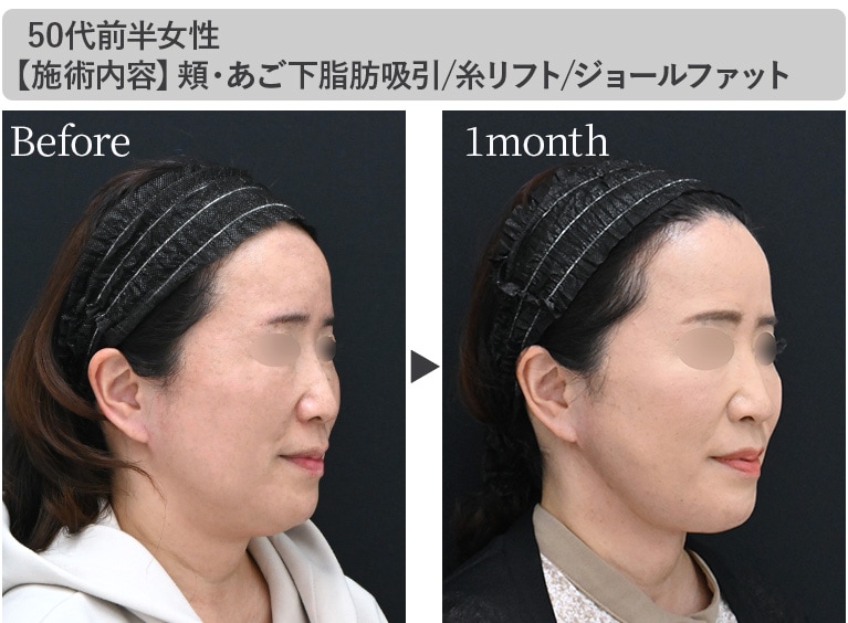 術後の経過とリアルな変化