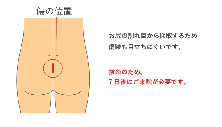 脂肪の採取部位はどこ?