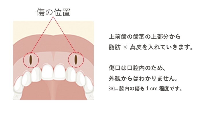 組み合わせたものを移植するのはどこ?