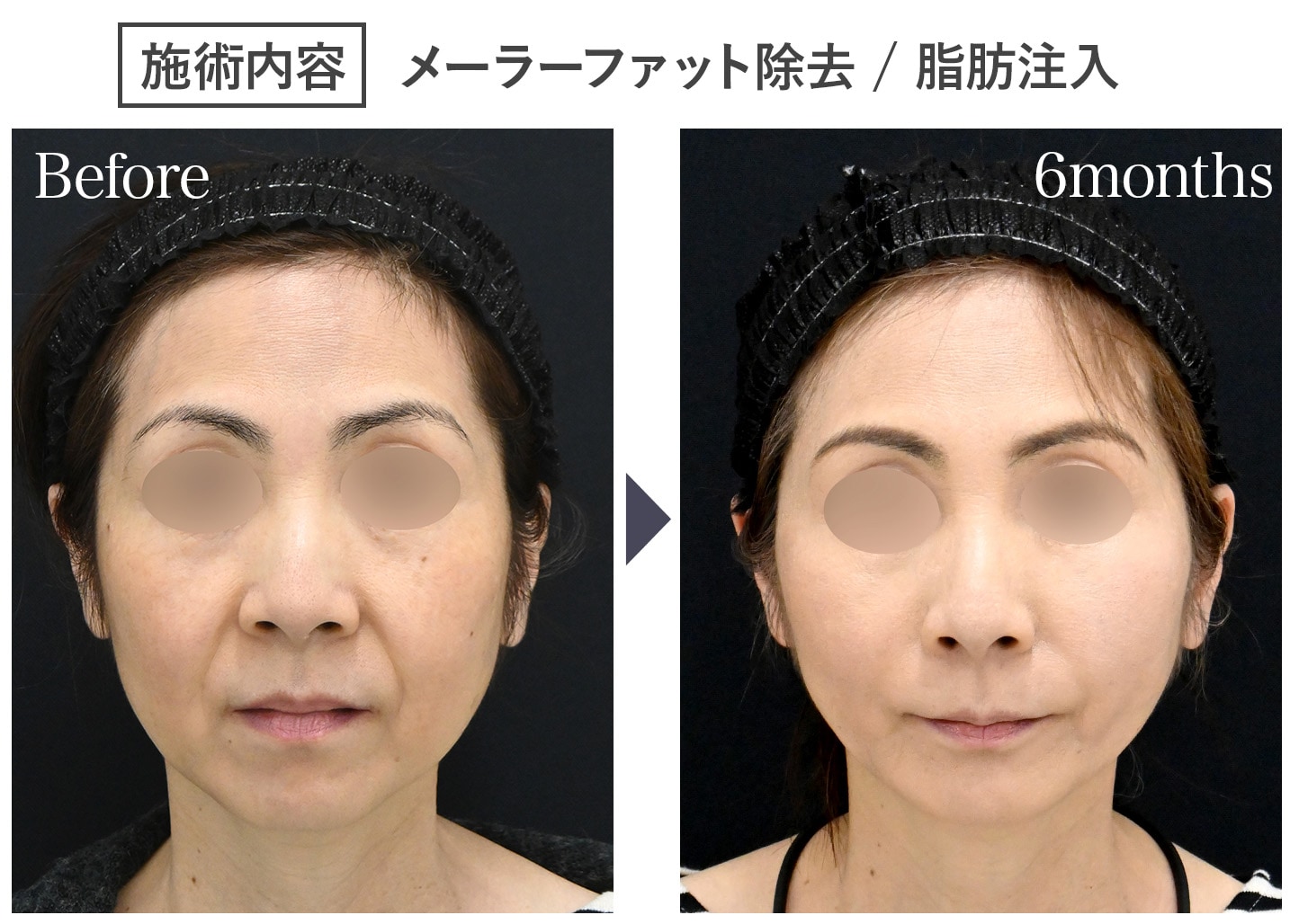垂れた脂肪を取り除き、ほうれい線の溝を浅くする