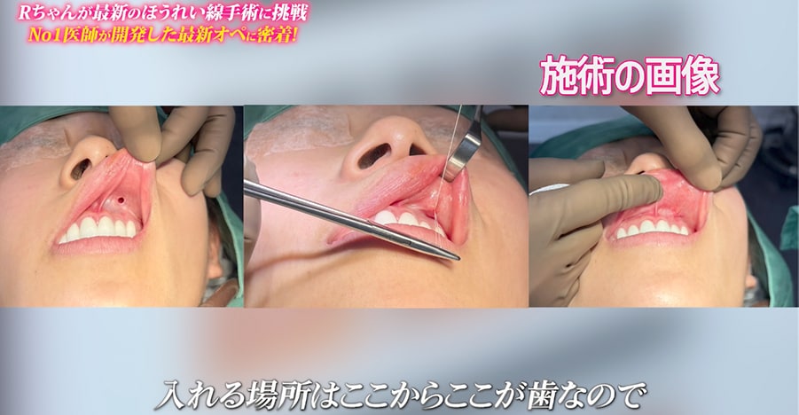 ■ 口の中から挿入するため、傷跡ゼロの治療