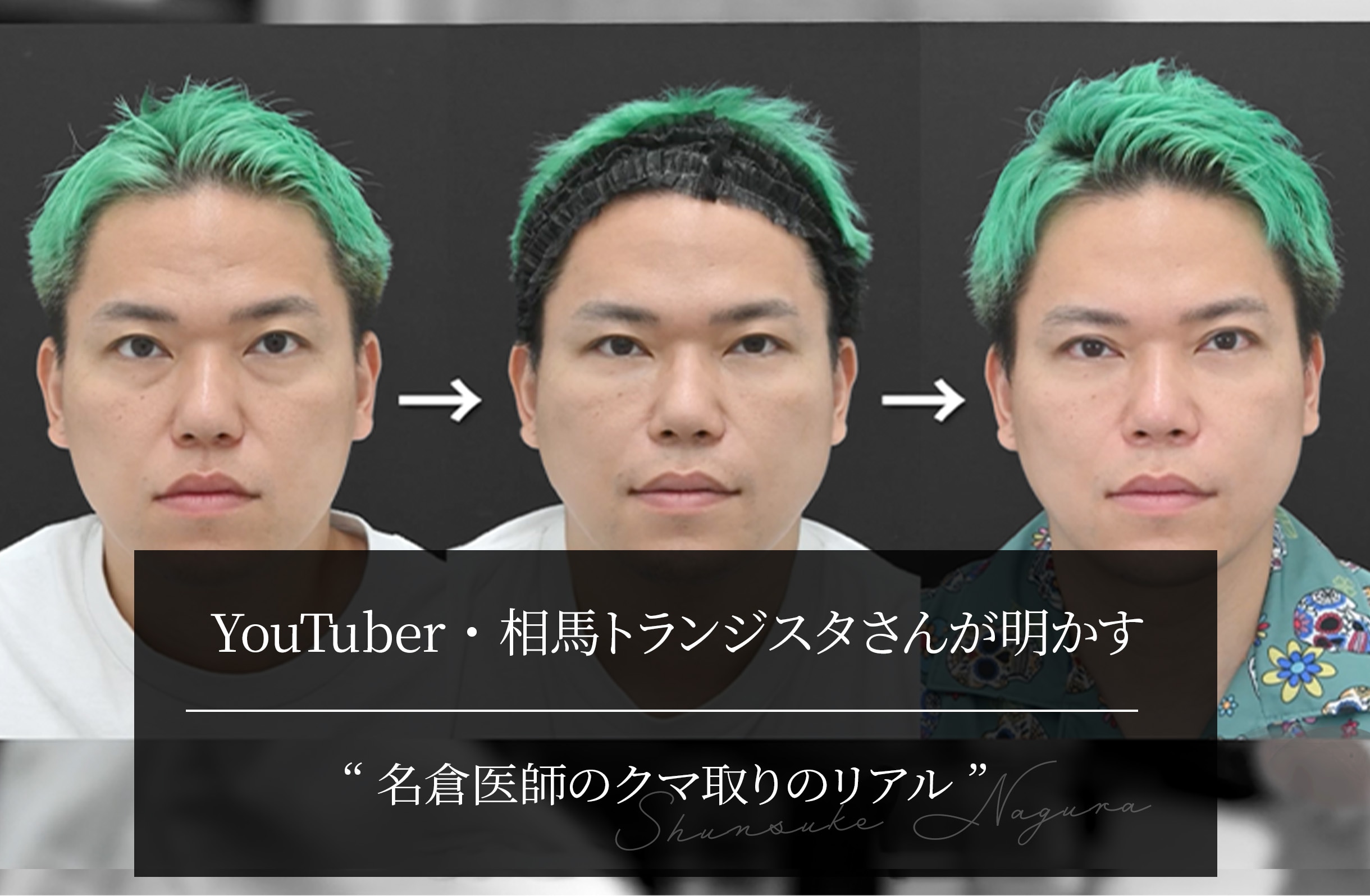 YouTuber・相馬トランジスタさんが明かす“名倉医師のクマ取りのリアル”