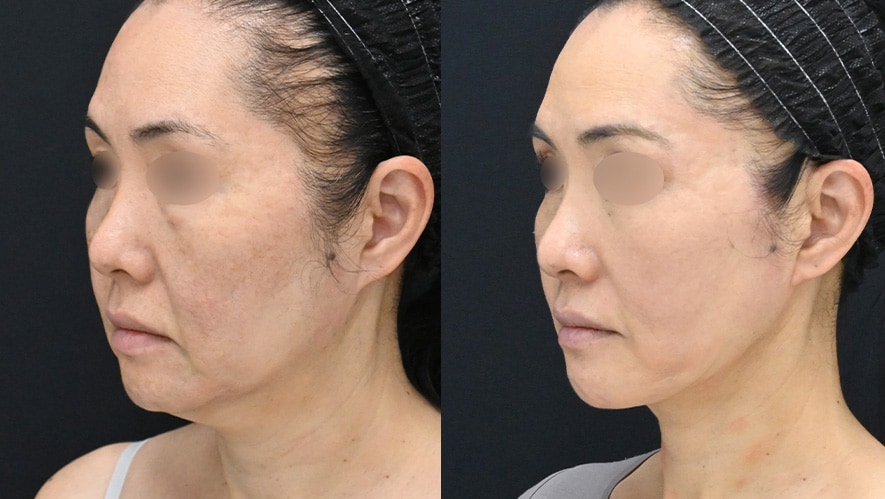 フェイスラインのゆるみとは何が起きている状態？