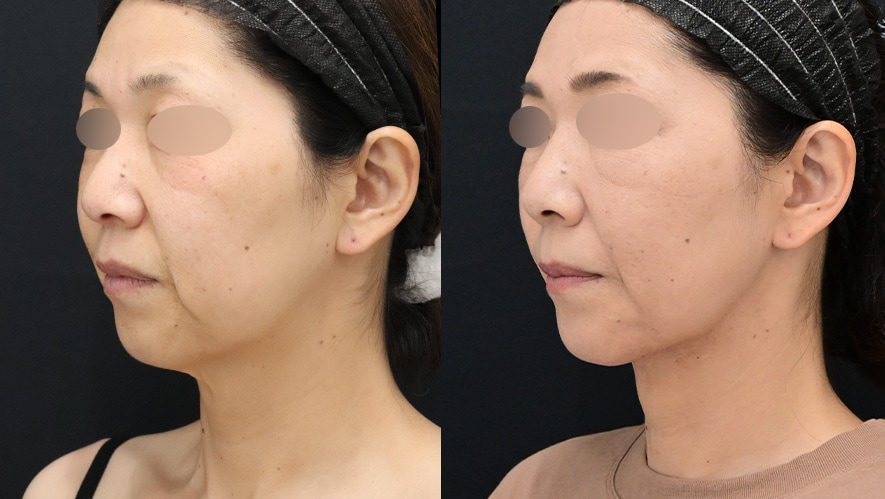 輪郭のたるみが始まりやすい場所