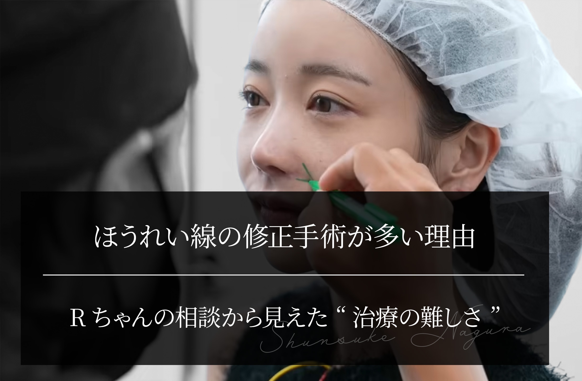 ほうれい線の修正手術が多い理由｜Rちゃんの相談から見えた“治療の難しさ”