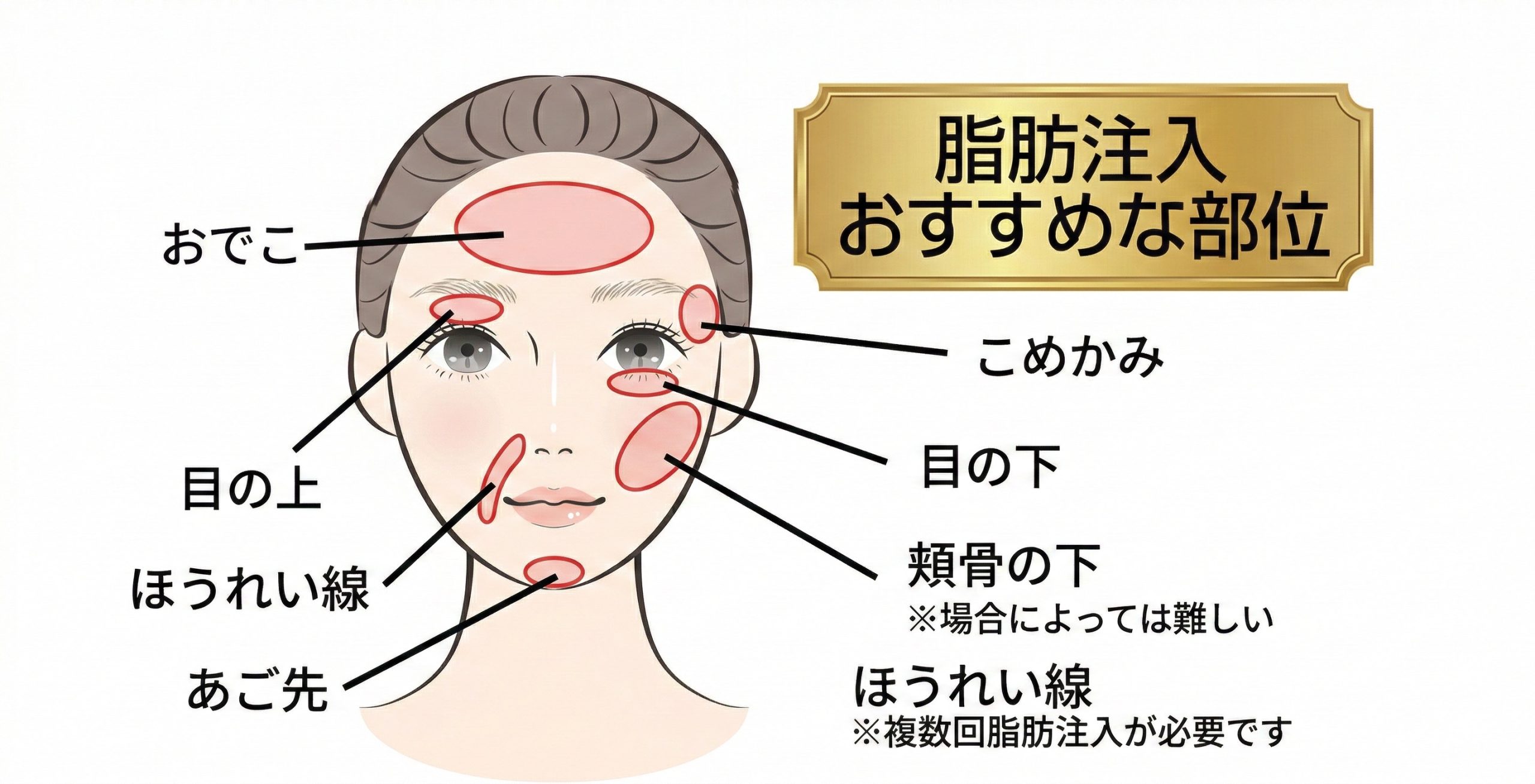 自分の脂肪を使った自然な若返り<br />
