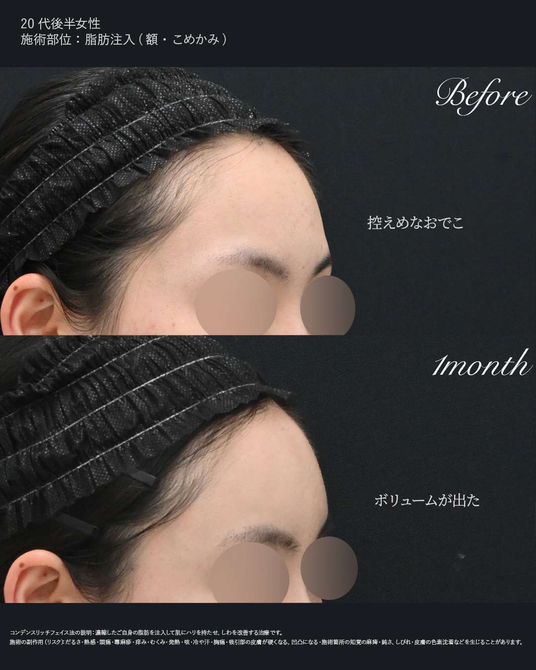 脂肪注入で改善できるケース<br />
