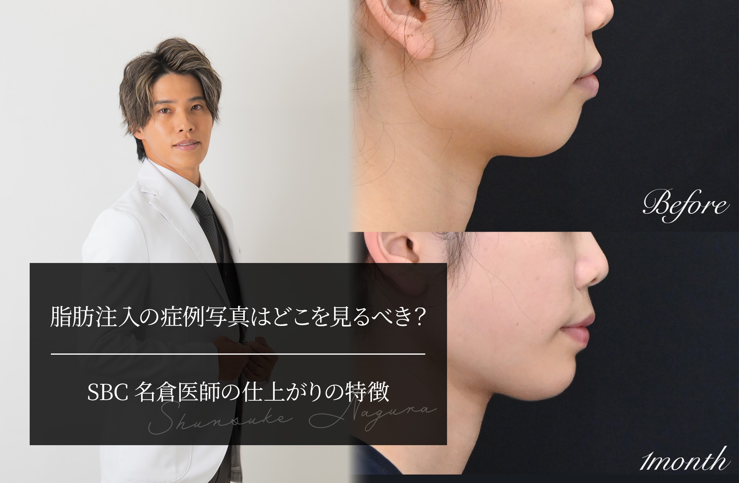 脂肪注入の症例写真はどこを見るべき？ SBC名倉医師の仕上がりの特徴