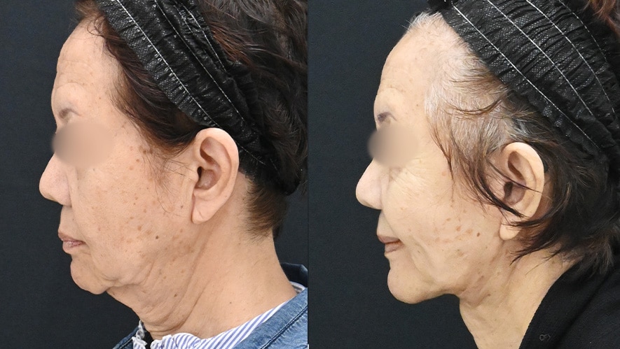 1. 「たるみ世代」の輪郭矯正は、外科医の総合格闘技