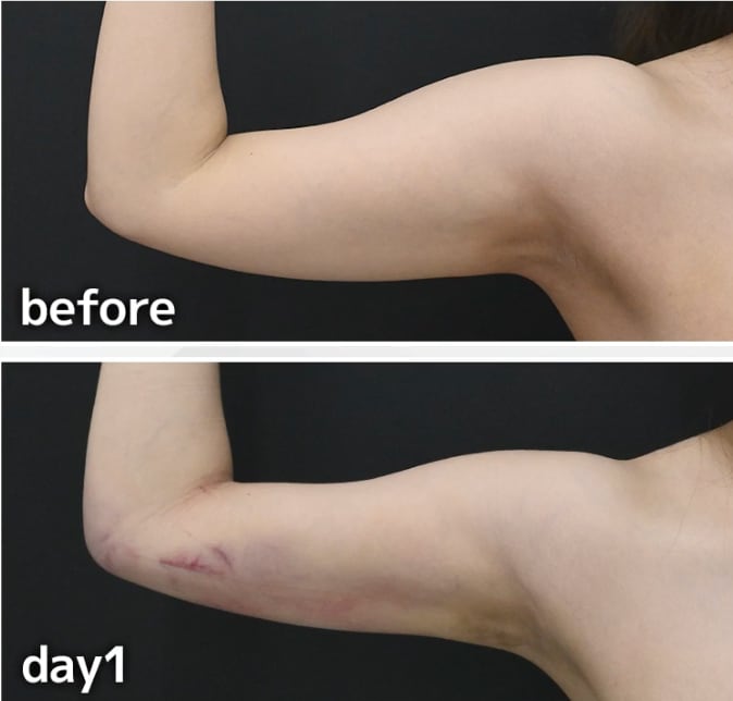 うっすら出る〜部分的に出るケースがほとんどです