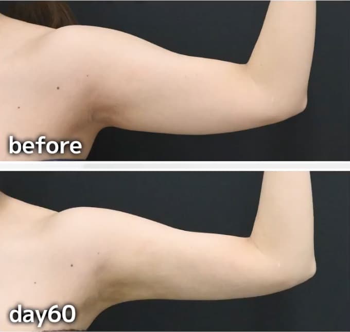 肩の同時吸引が鍵