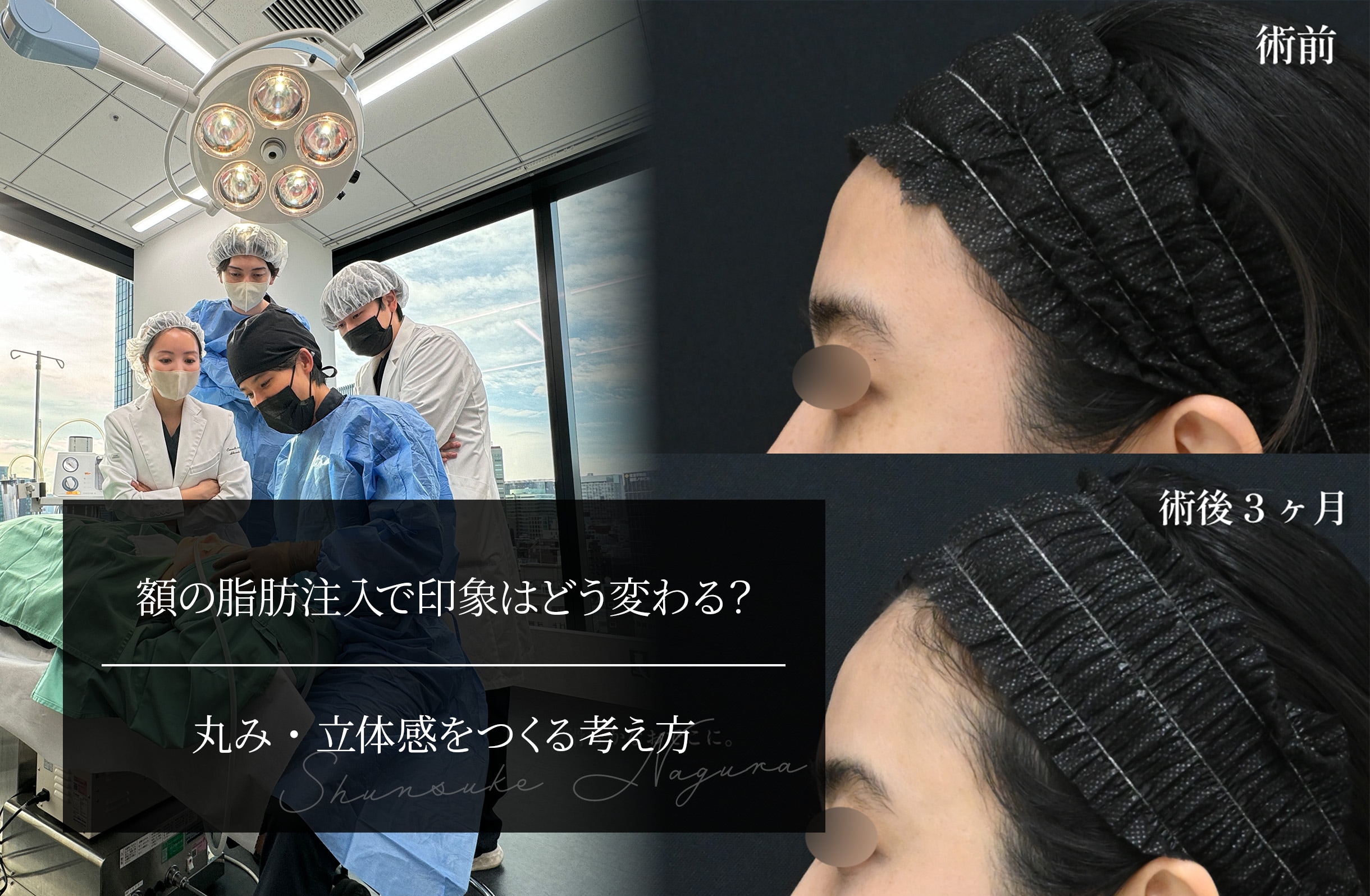 額の脂肪注入で印象はどう変わる？ 丸み・立体感をつくる考え方