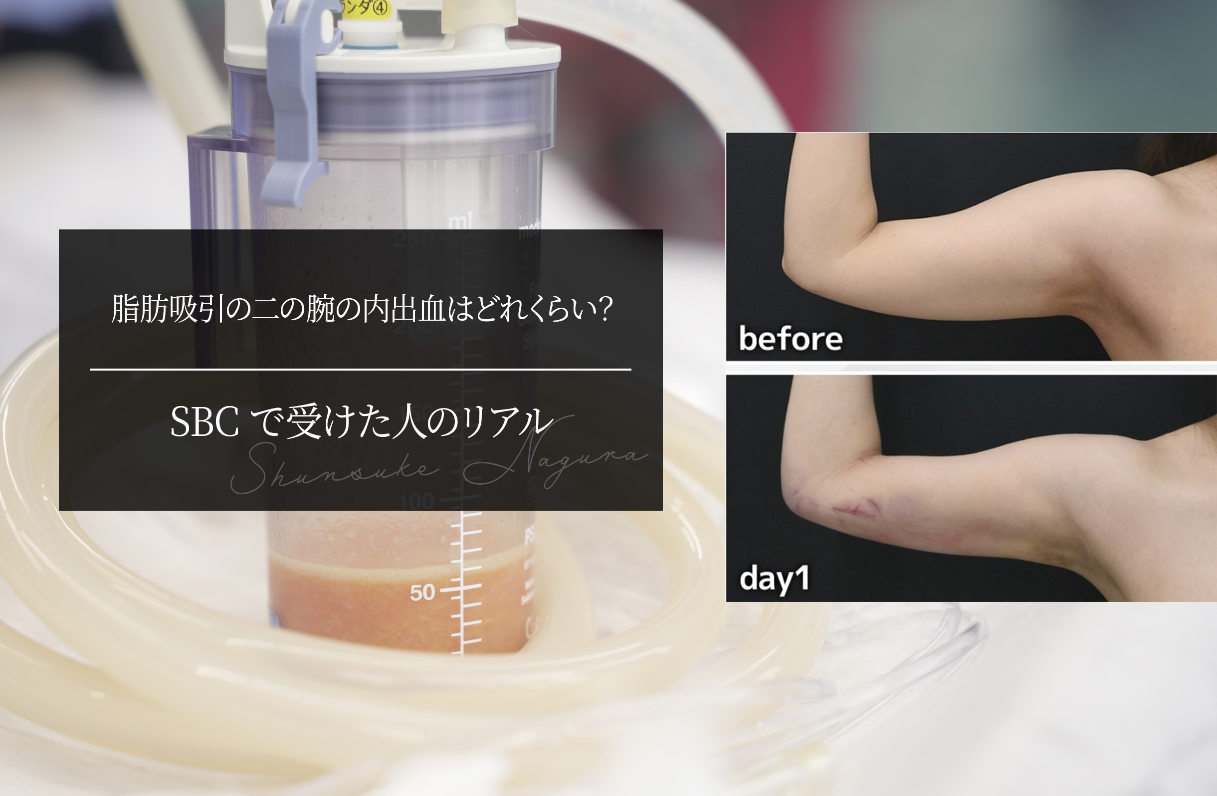 脂肪吸引の二の腕の内出血はどれくらい？SBCで受けた人のリアル