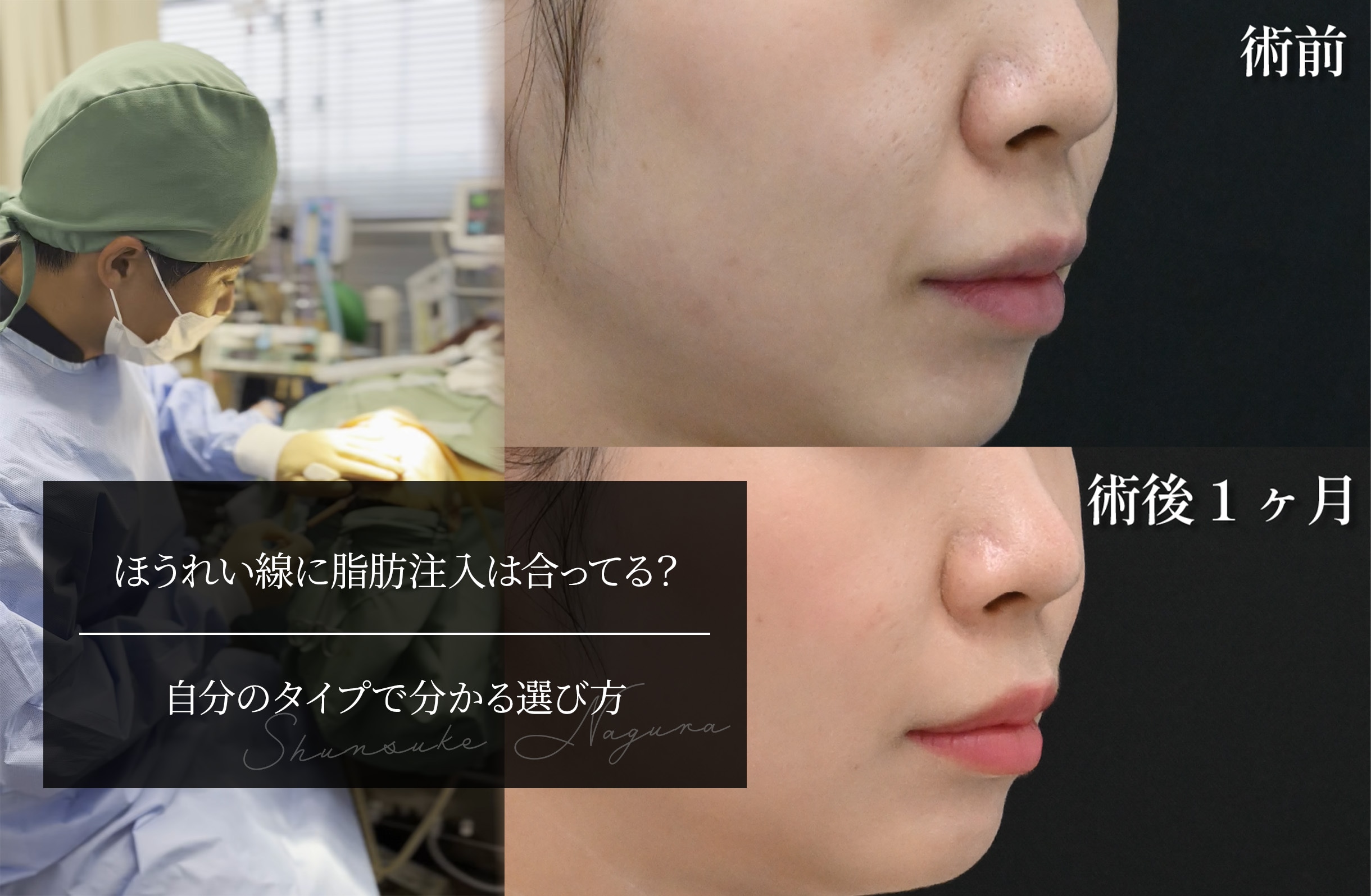 ほうれい線に脂肪注入は合ってる？ 自分のタイプで分かる選び方