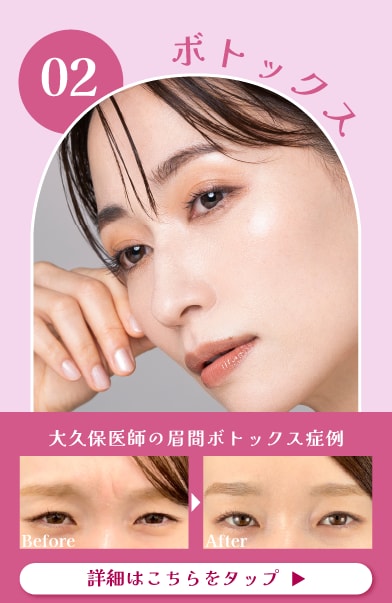 【ボトックス】リピーター多数のシワ改善＆予防ができる人気注射✨