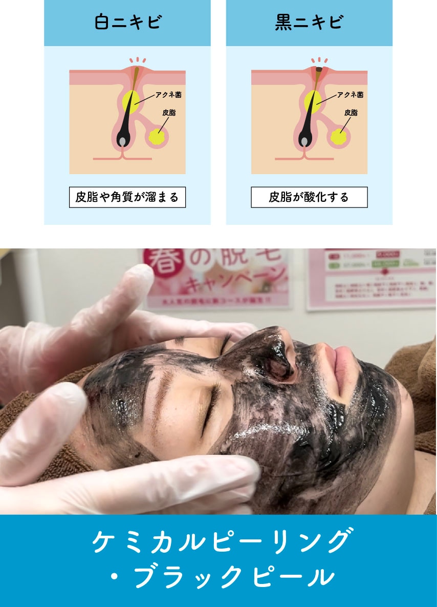 白ニキビ・黒ニキビを治すポイントは「皮脂」