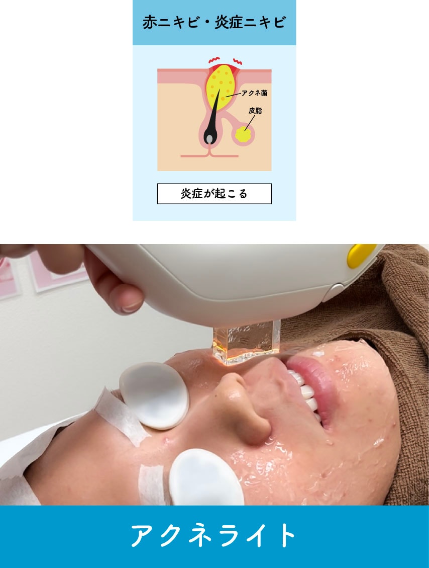 赤ニキビ・炎症ニキビの鍵は「殺菌」